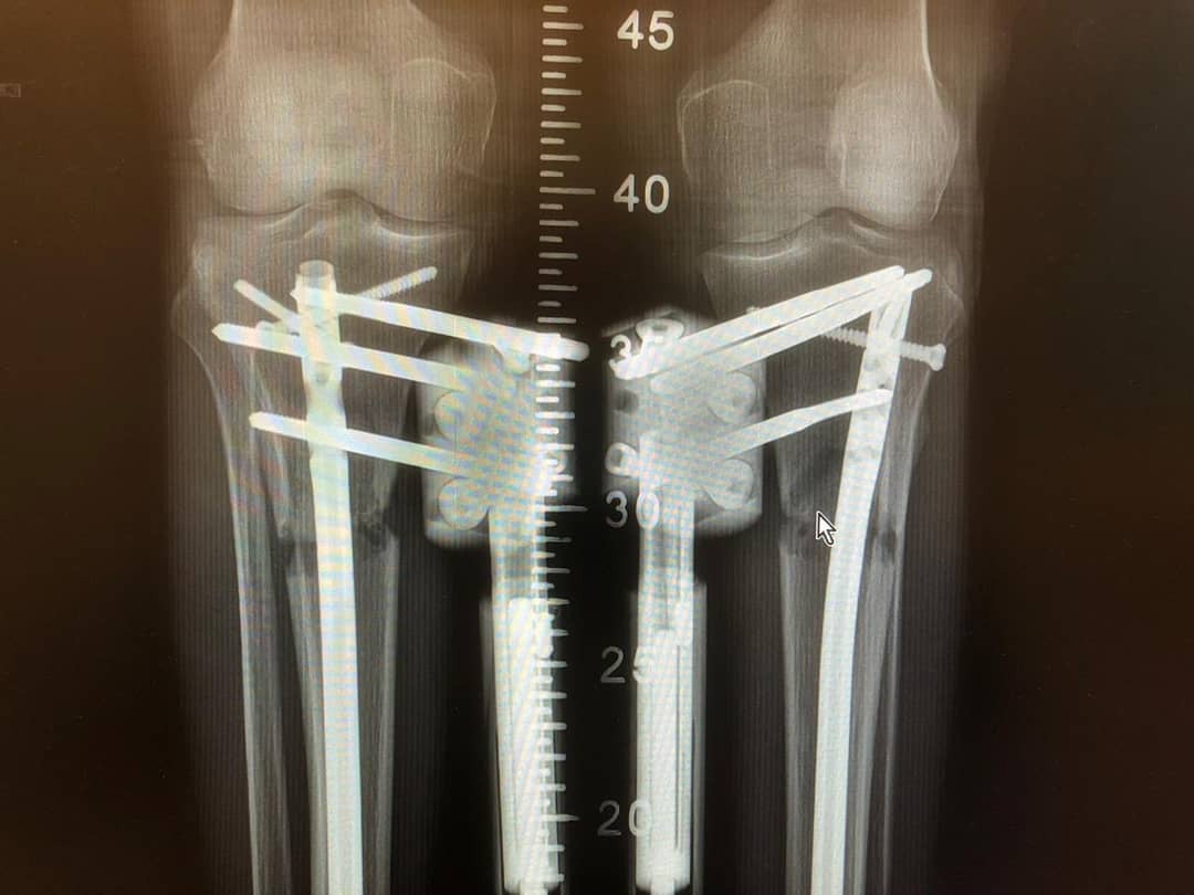 Inside the world of limblengthening surgery The Independent